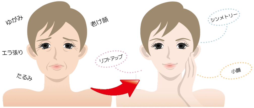 小顔矯正,ビフォーアフター
